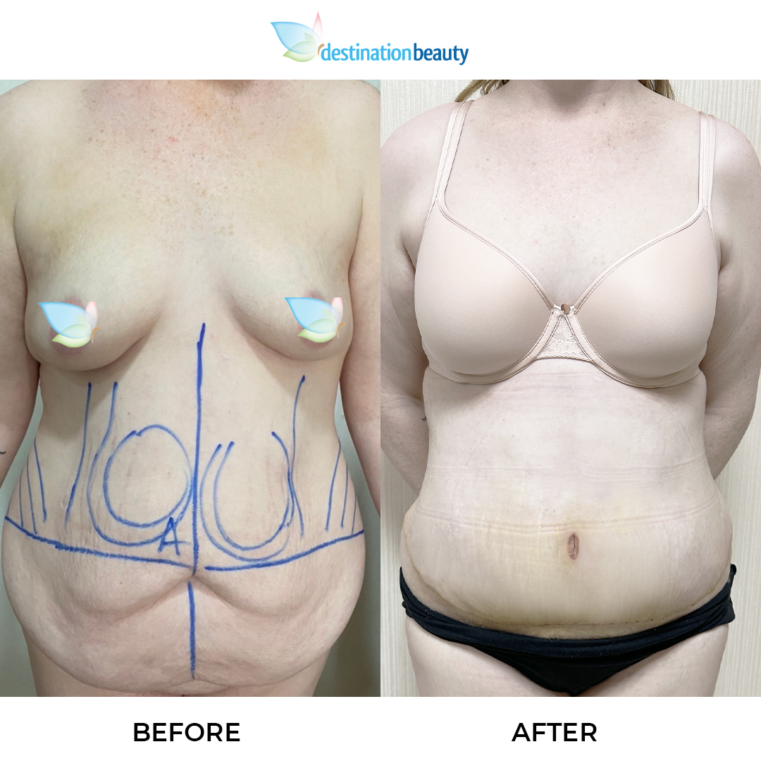 Julia extended tummy tuck and liposuction