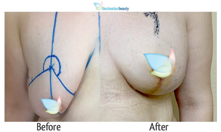 breast augmentation with lift thailand