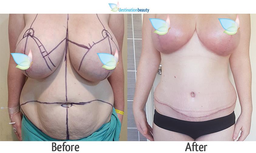 tummy tuck and breast reduction