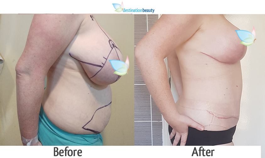 breast reduction and tummy tuck thailand