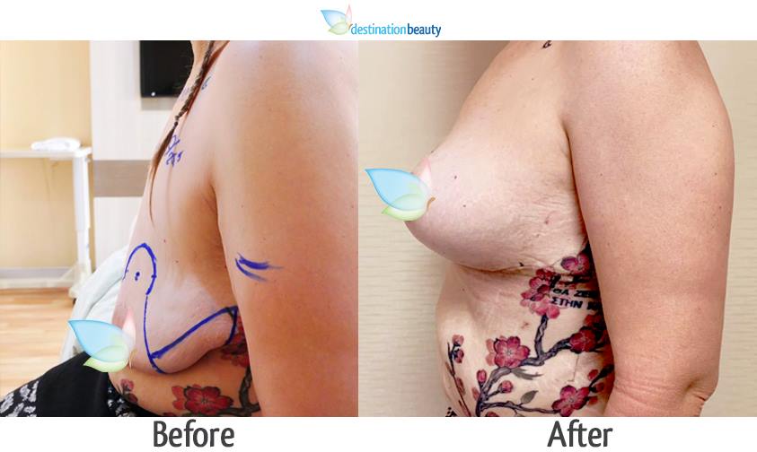 breast lift with small implants