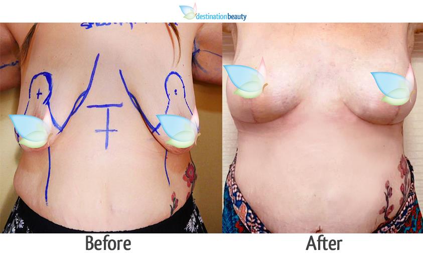 breast lift with small implants 200cc