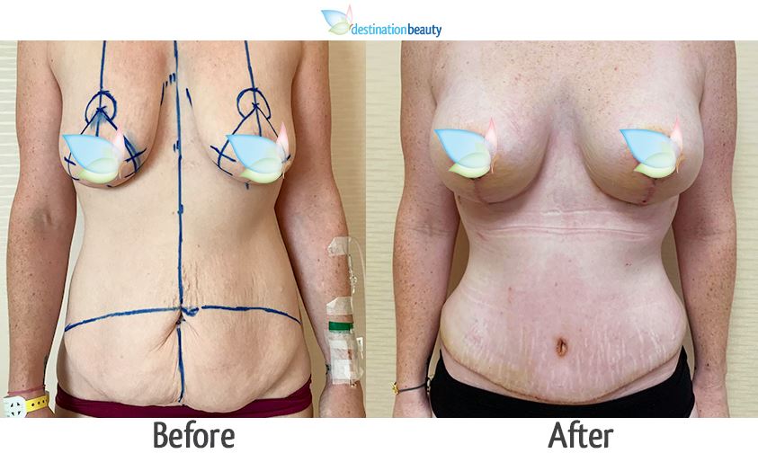 Before and after pictures of breast lift with small implants 225 cc and tummy tuck - 12 days post op