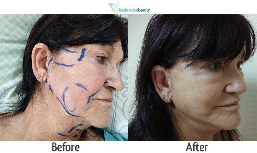 Before and after pictures of mid face with neck lift