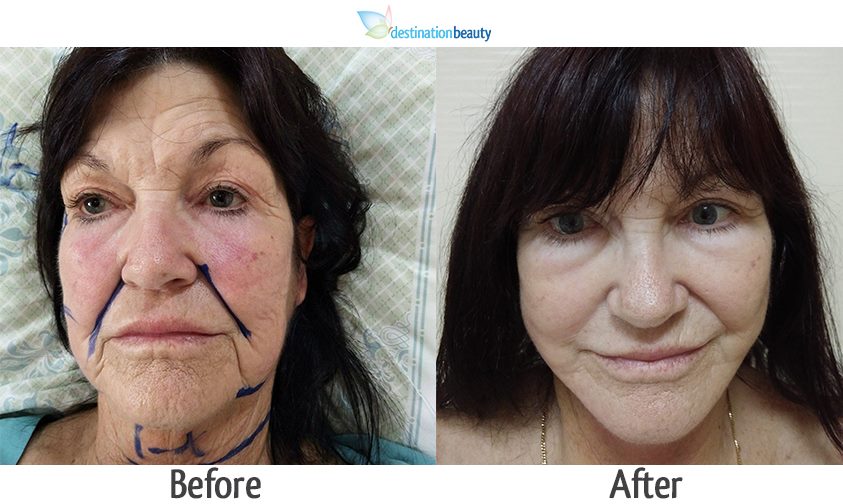 mid face and neck lift thailand 