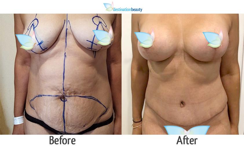breast augmentation with lift and tummy tuck