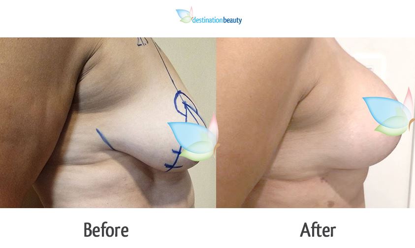 breast augmentation with lift and tummy tuck
