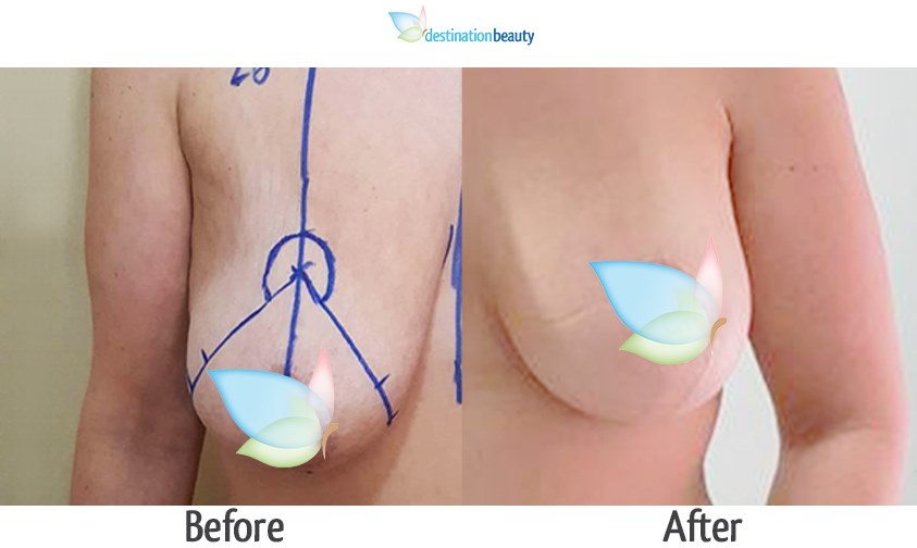 breast reduction with implants