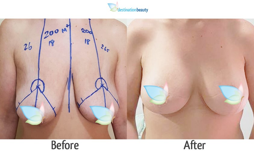 breast reduction with implants