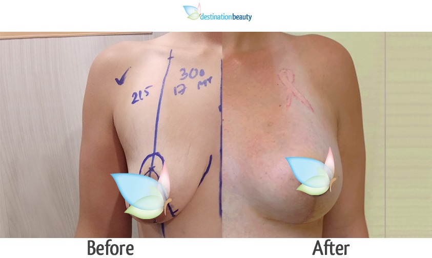 breast augmentation with lift