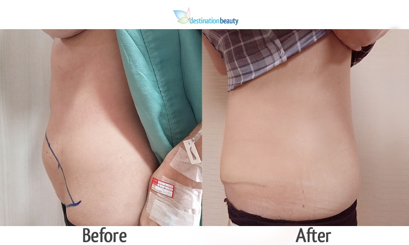 tummy tuck