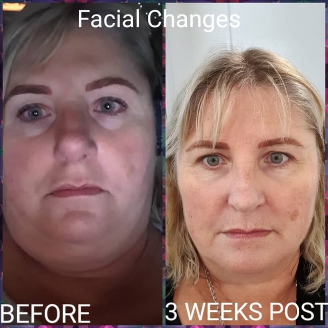 tina gastric sleeve