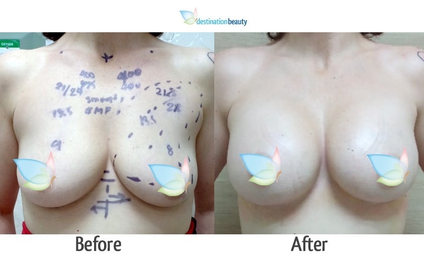 dell breast augmentation