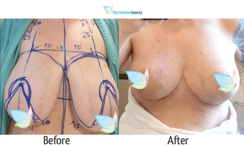 amanda breast reduction