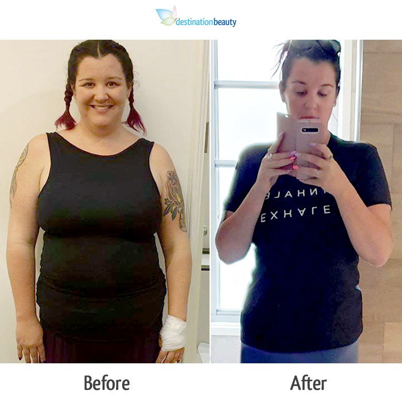 brooke gastric sleeve