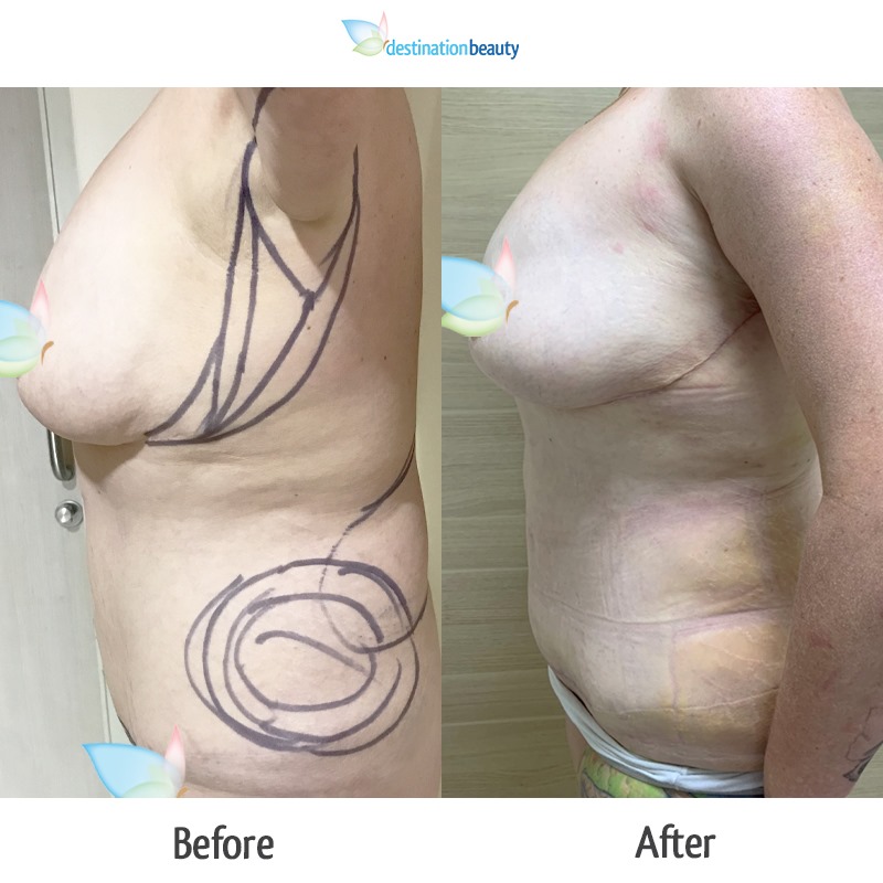 michelle skin removal surgery