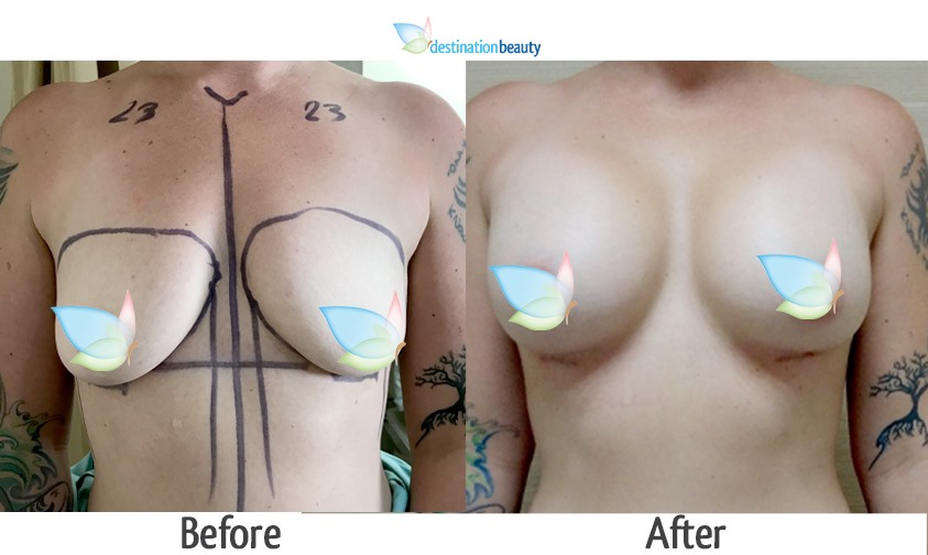 hanna breast augmentation