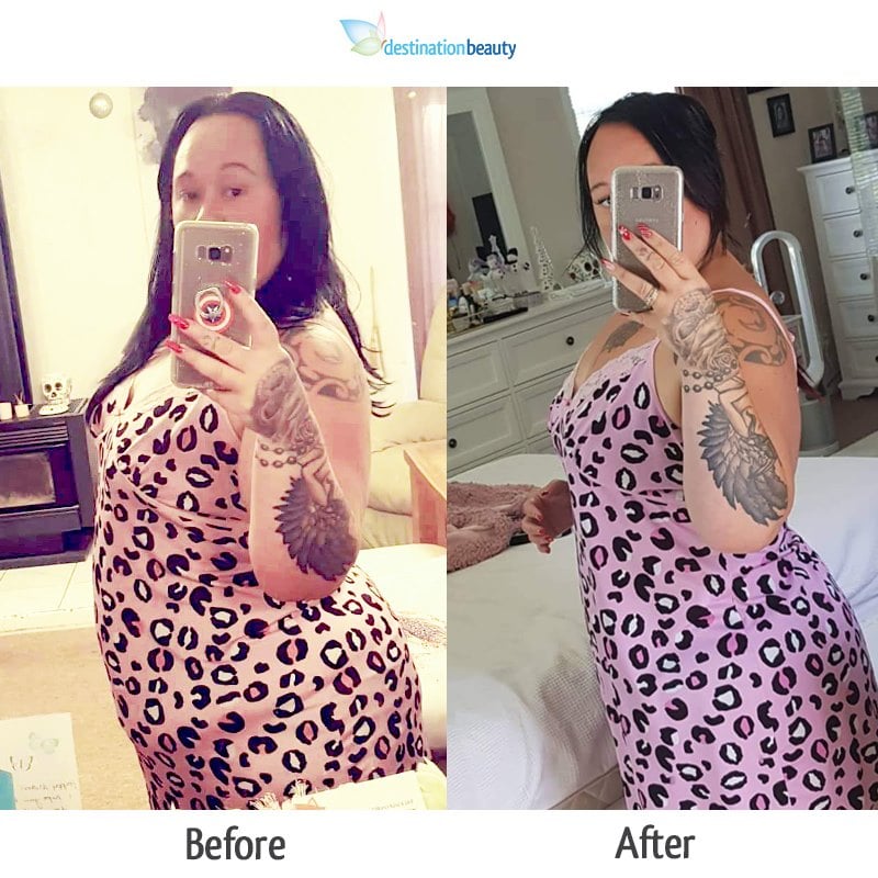Gastric sleeve surgery in Thailand Kelly lost 30 kgs 5 month after