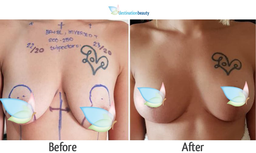 Jessica breast augmentation with lift