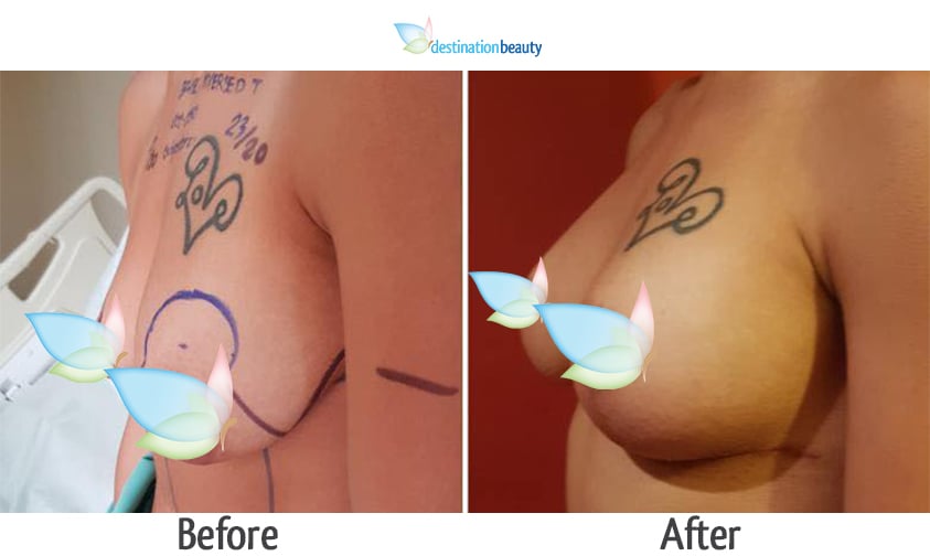 Jessica breast augmentation with lift