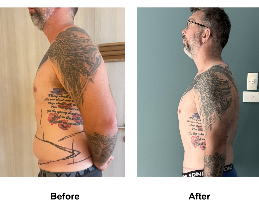 Aaron had ExTT + VASER 2 areas on upper abs and love handles + Mons lift with Dr. Weerachai (1)