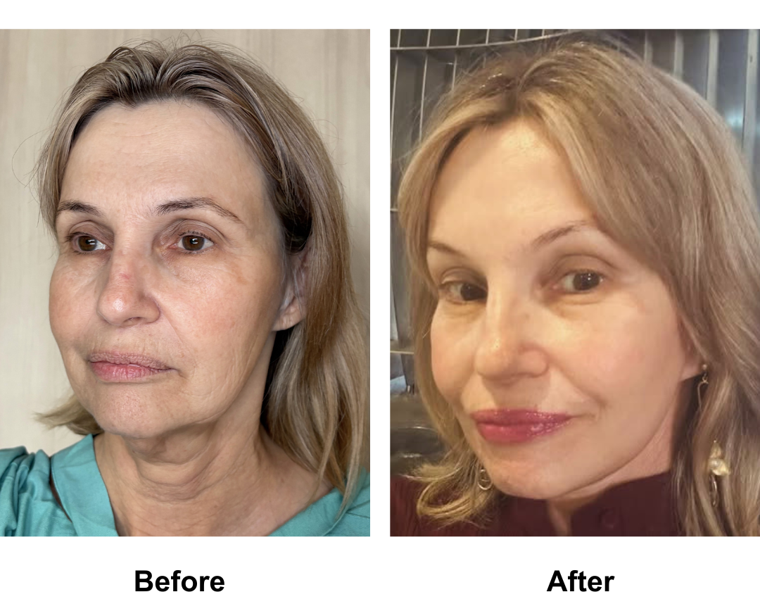 Ada had FFNL + Chin lift + EBL with Dr. Ring - 3 months (2)