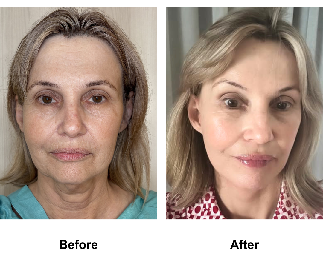 Ada had FFNL + Chin lift + EBL with Dr. Ring - 3 months
