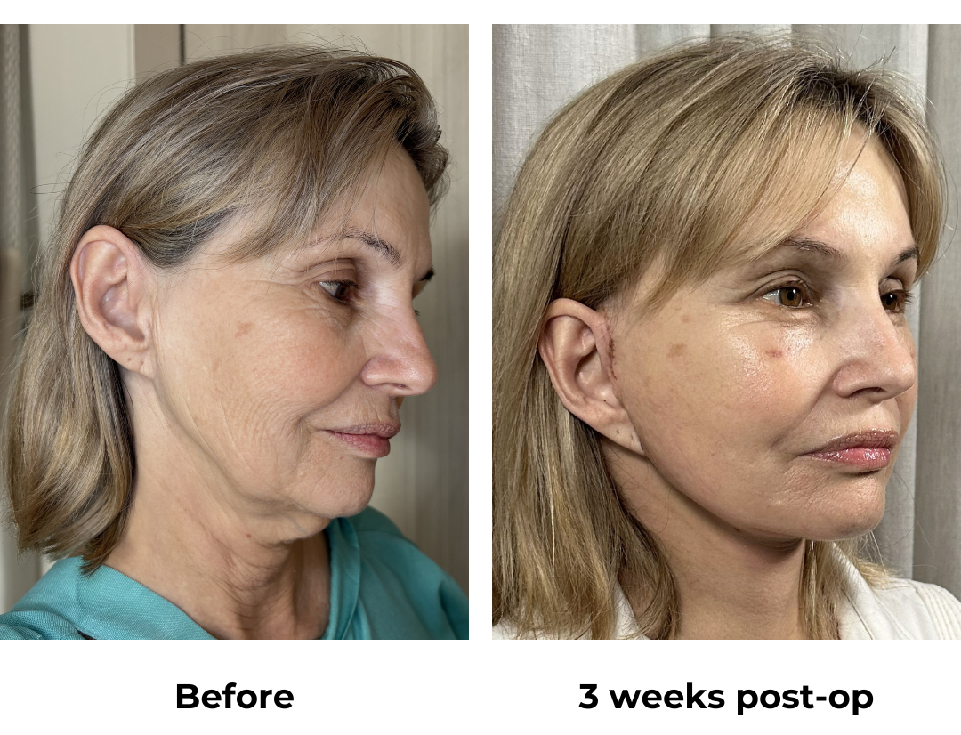 Ada had MFNL + Chin lift + Arm lift + EBL with Dr. Ring   (2)