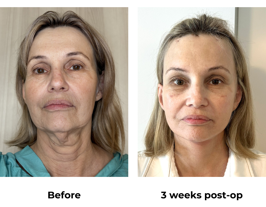 Ada had MFNL + Chin lift + Arm lift + EBL with Dr. Ring   (3)