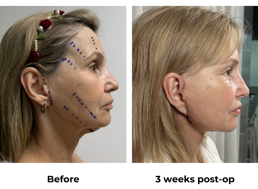 Ada had MFNL + Chin lift + Arm lift + EBL with Dr. Ring   (4)