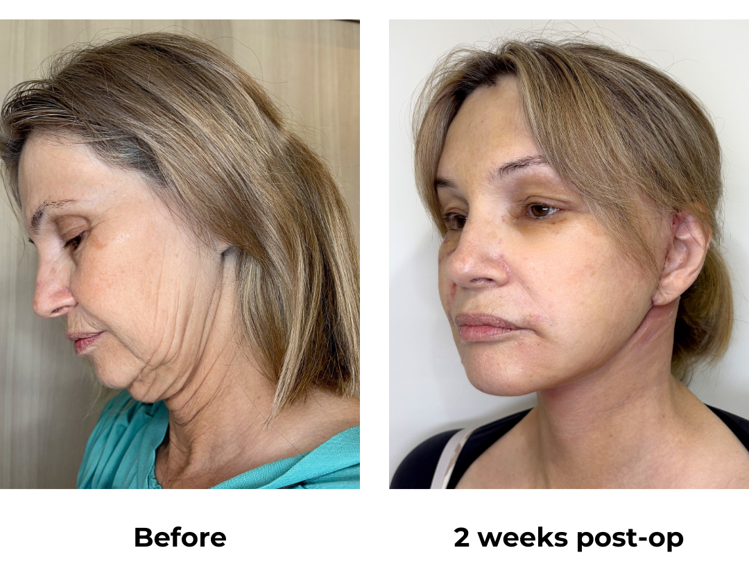 Ada had MFNL + Chin lift + Arm lift + EBL with Dr. Ring