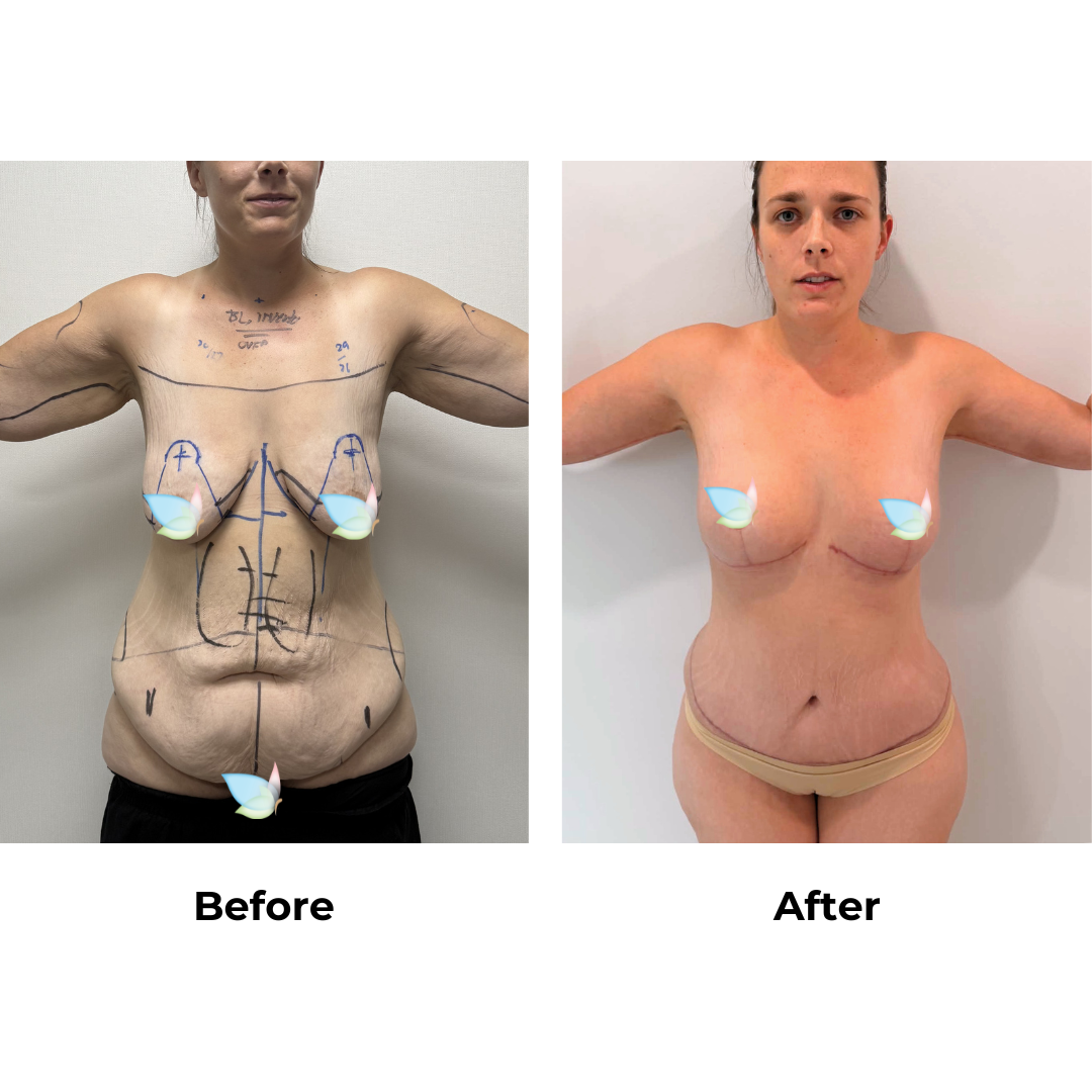 Ahteasha had Extended Tummy Tuck, Mons Lift, Arm Lift, Breast Reduction, and Liposuction to the upper abdomen, love handles, and arms with Dr. Kasemsak