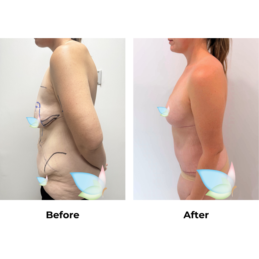 Ahteasha had Extended Tummy Tuck, Mons Lift, Arm Lift, Breast Reduction, and Liposuction to the upper abdomen, love handles, and arms with Dr. Kasemsak