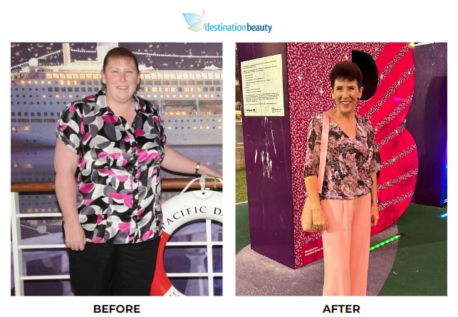 Alison weight loss surgery 2