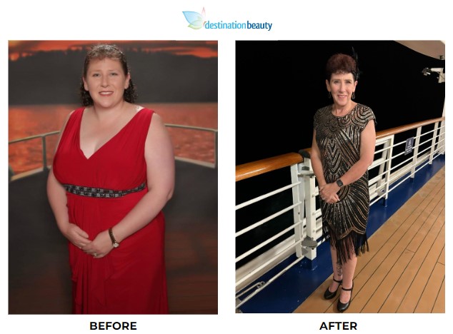 Alison weight loss surgery