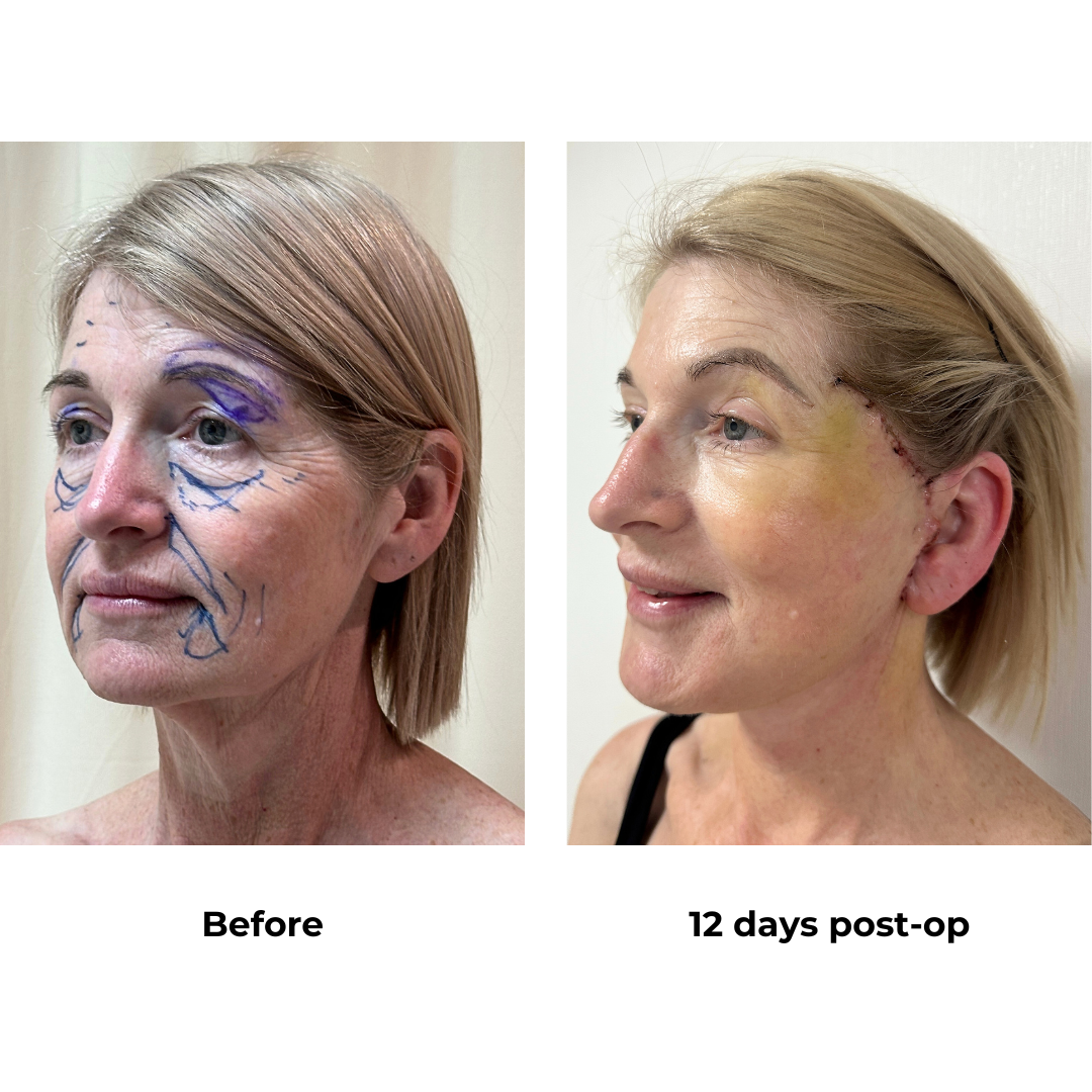 Allese had FFNL + Sub Brow with Dr. NJ (3)