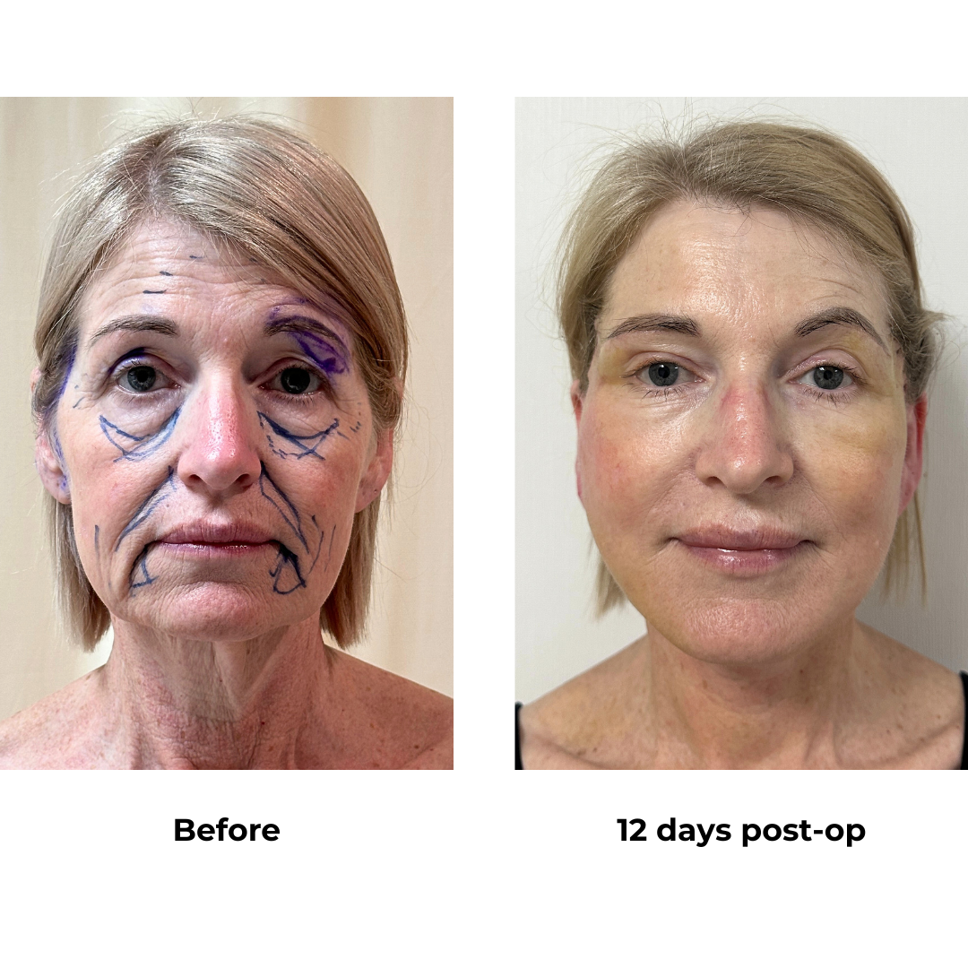 Allese had FFNL + Sub Brow with Dr. NJ