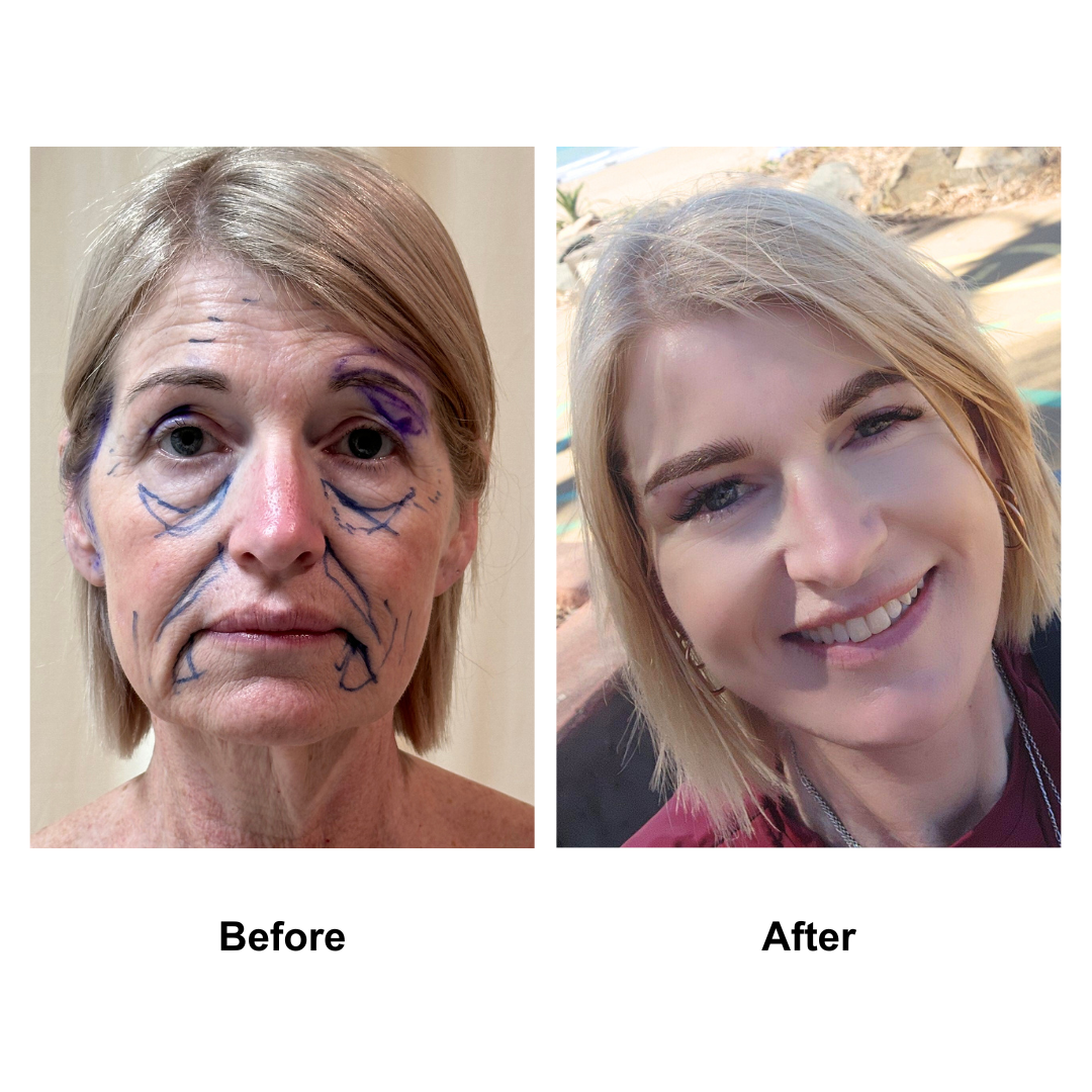 Allese had facelift with Dr. NJ (1)