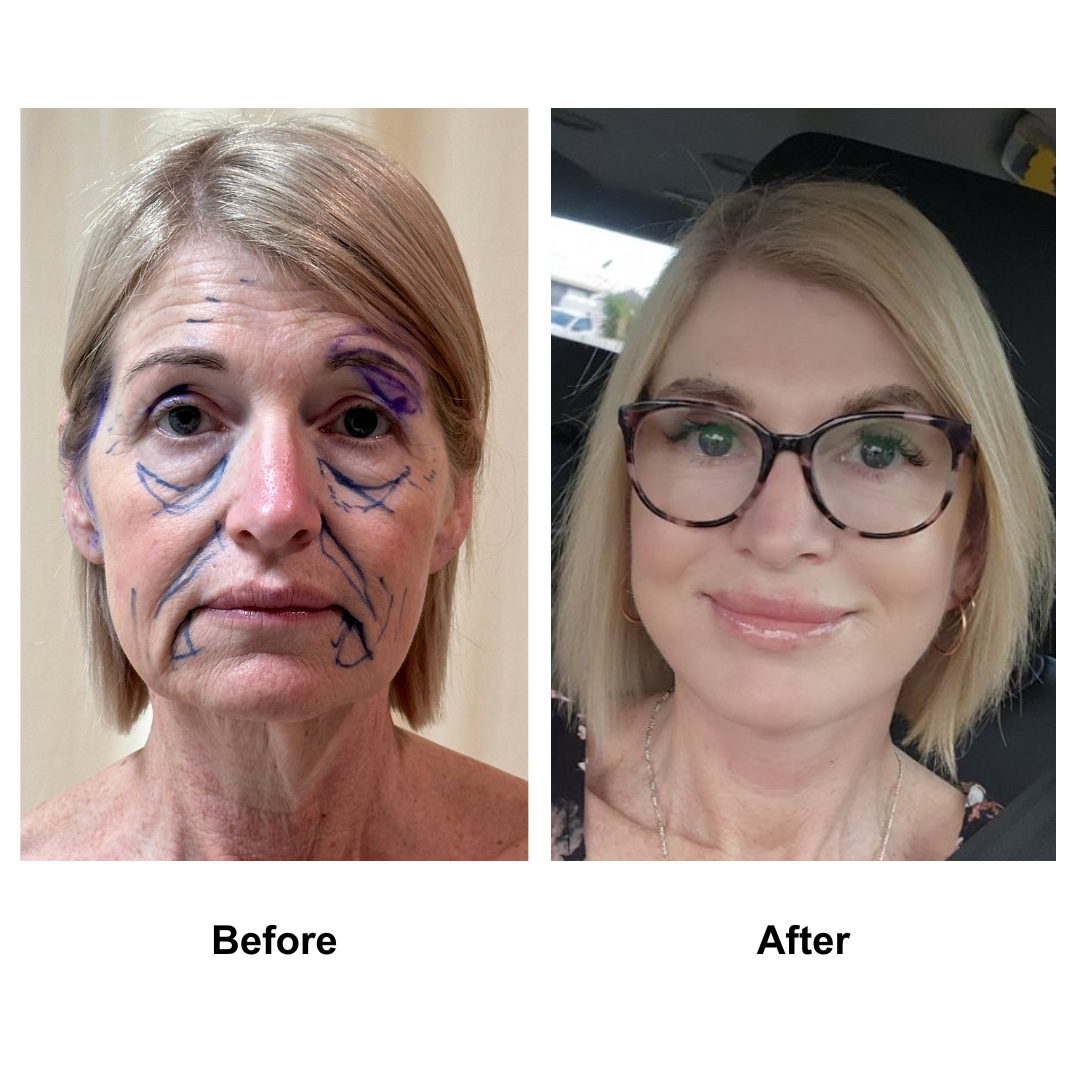 Allese had facelift with Dr. NJ