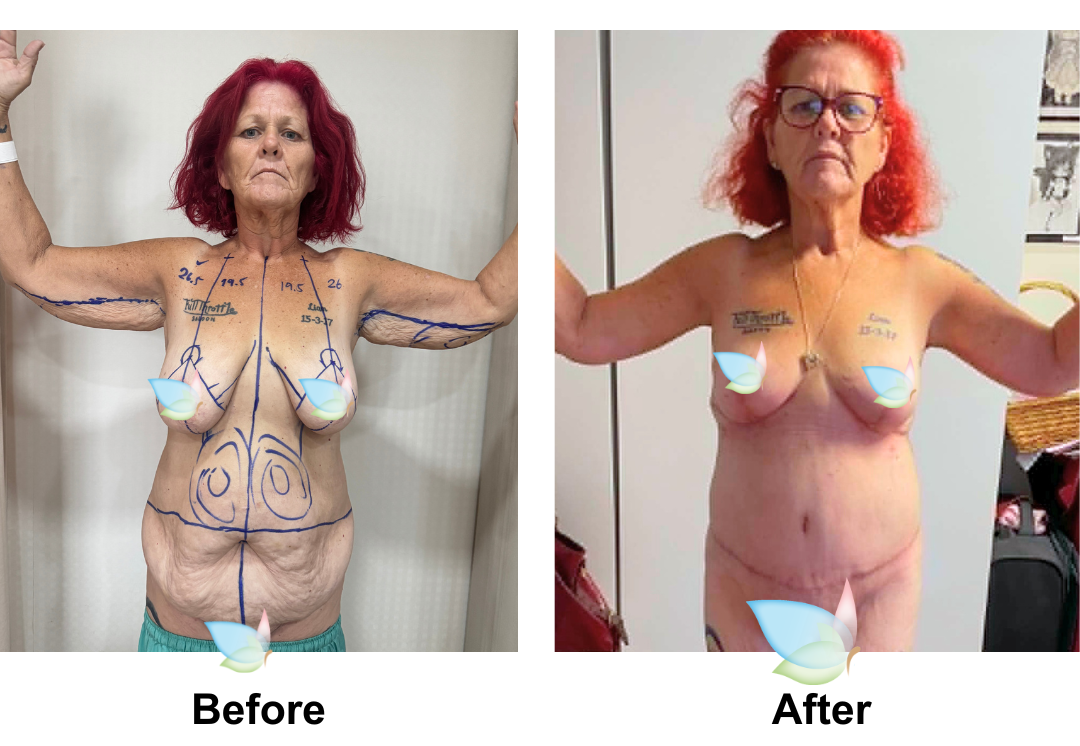 Ally had BL + AL + Lipo arms + ExTT + ML + Lipo2 (upper abs, love handles) with Dr. Angkaka  (1)