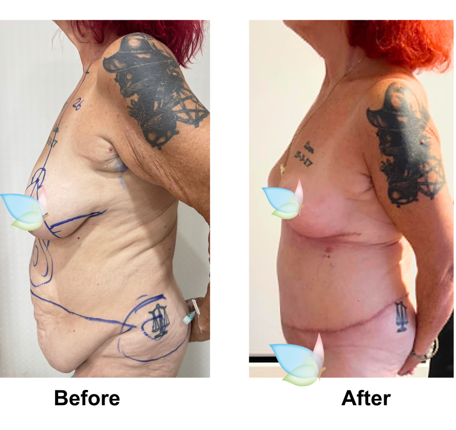 Ally had BL + AL + Lipo arms + ExTT + ML + Lipo2 (upper abs, love handles) with Dr. Angkaka  (2)