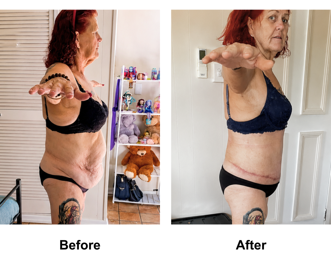 Ally had BL + AL + Lipo arms + ExTT + ML + Lipo_2 (upper abs, love handles) with Dr. Angkaka (2)