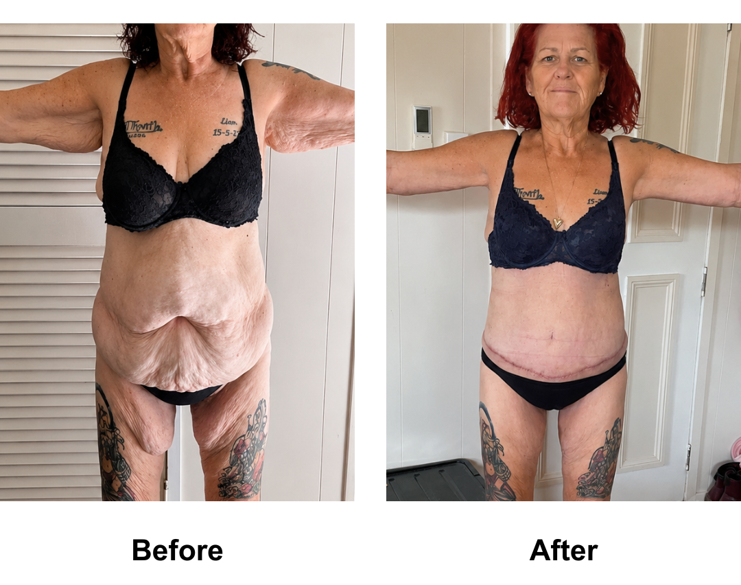 Ally had BL + AL + Lipo arms + ExTT + ML + Lipo_2 (upper abs, love handles) with Dr. Angkaka