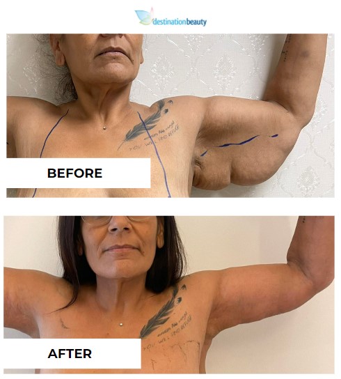 Amanda before after arm lift