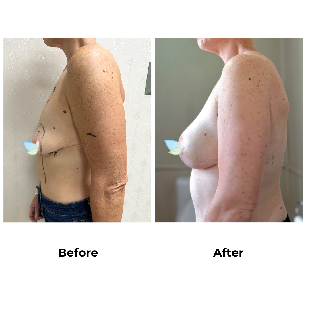 Amanda had breast augmentation with lift with Dr. Kasemsak (2)