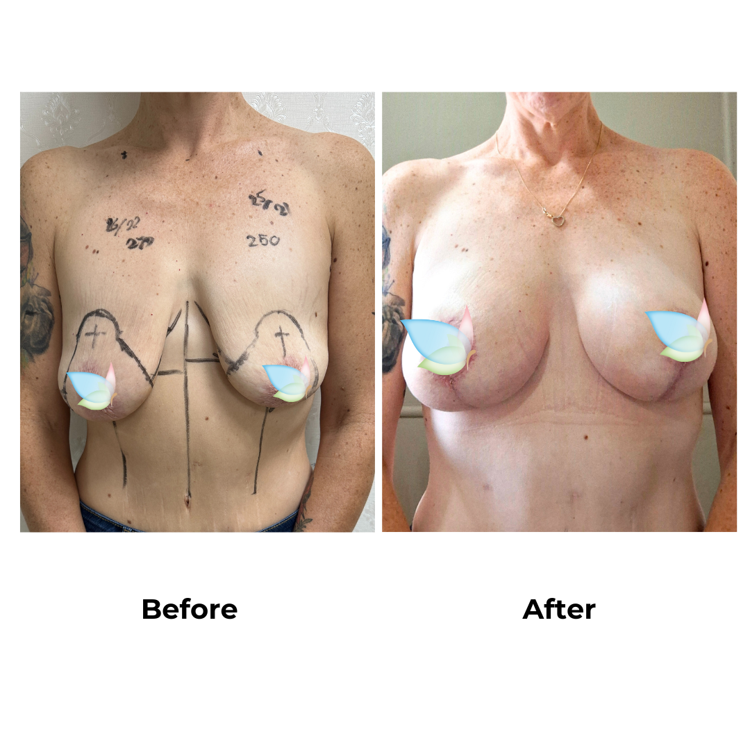 Amanda had breast augmentation with lift with Dr. Kasemsak