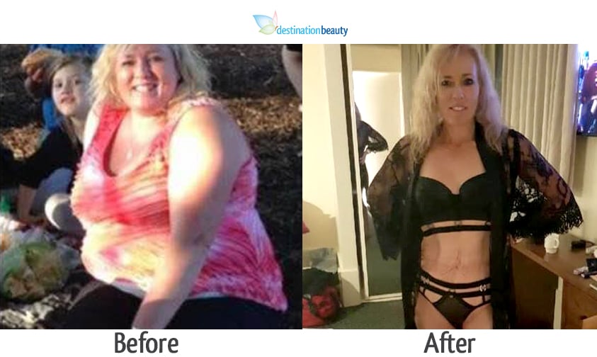 Amanda weight loss surgery