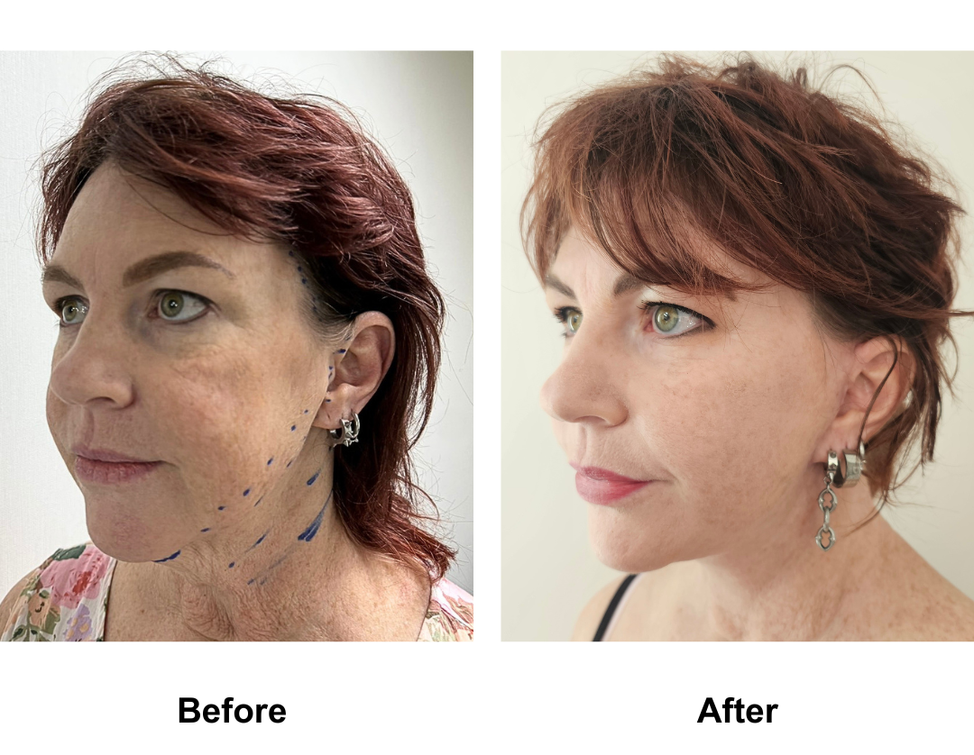Amy had MFNL + Chin Lift with Dr. Ring (2)