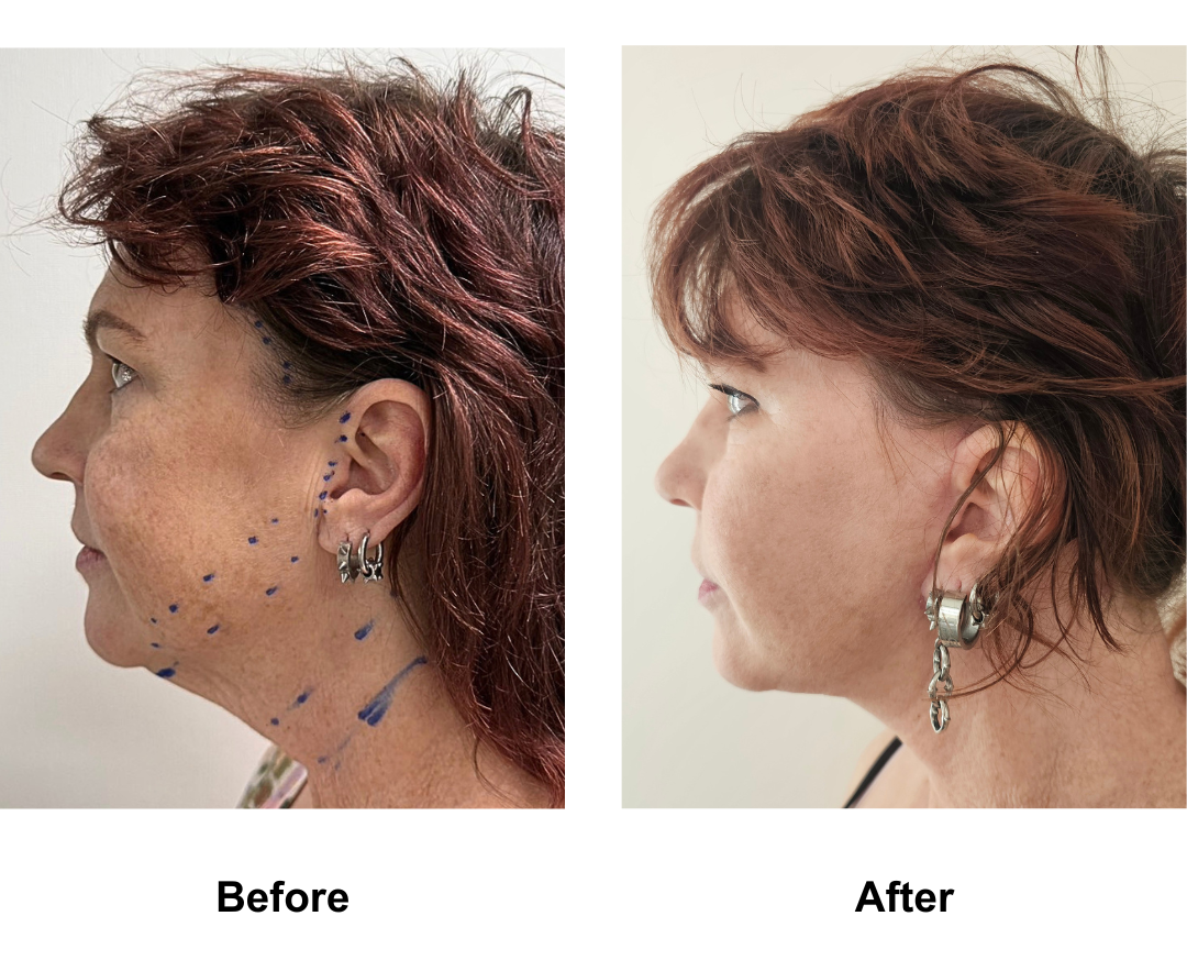 Amy had MFNL + Chin Lift with Dr. Ring (3)