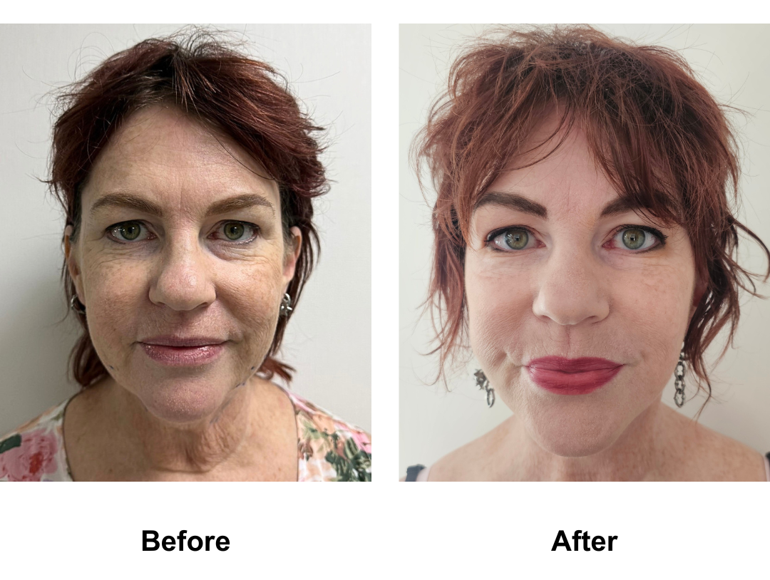 Amy had MFNL + Chin Lift with Dr. Ring